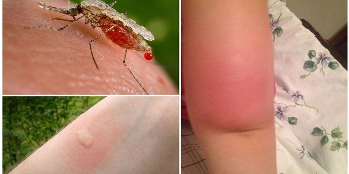 аллергия на укус насекомых